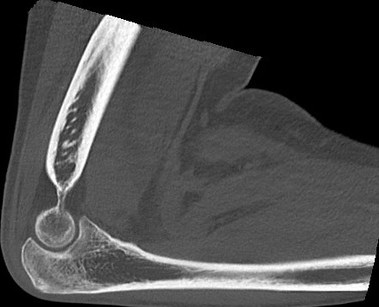 CT Scan (L) Elbow